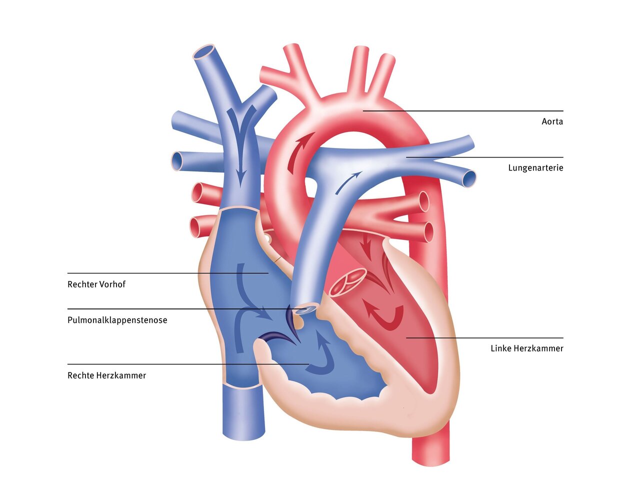 Das Bild zeigt eine schematische Darstellung des menschlichen Herzens mit wichtigen Teilen beschriftet, darunter rechter Vorhof, rechte Herzkammer, linke Herzkammer, Aorta und Lungenarterie. Pfeile verdeutlichen die Blutflussrichtungen im Herzen.