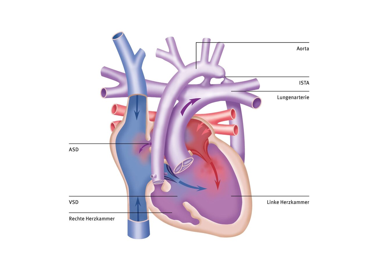 Das Bild zeigt eine anatomische Darstellung des Herzens mit sichtbaren Strukturen wie der Aorta, Lungenarterie, sowie den linken und rechten Herzkammern. Markierungen kennzeichnen ASD und VSD, zwei Arten von Herzklappenfehlern. Die Blutflussrichtung ist durch Pfeile angedeutet.