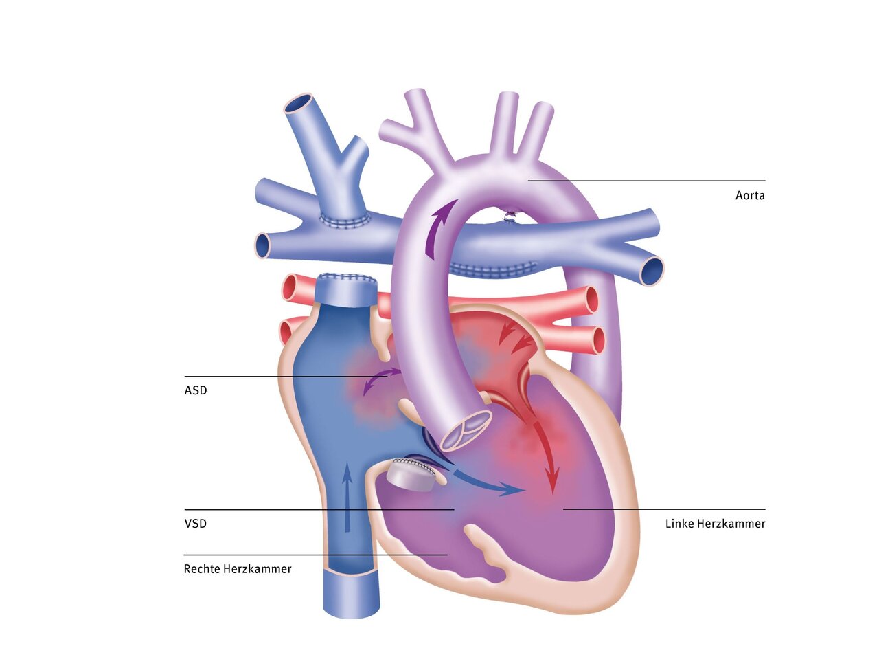 Illustration eines menschlichen Herzens mit beschrifteten Komponenten, darunter die linke und rechte Herzkammer, die Aorta, ASD (atrialer Septumdefekt) und VSD (ventrikulärer Septumdefekt). Die Farbgebung verdeutlicht den Blutfluss zwischen den Kammern und zu den großen Blutgefäßen.