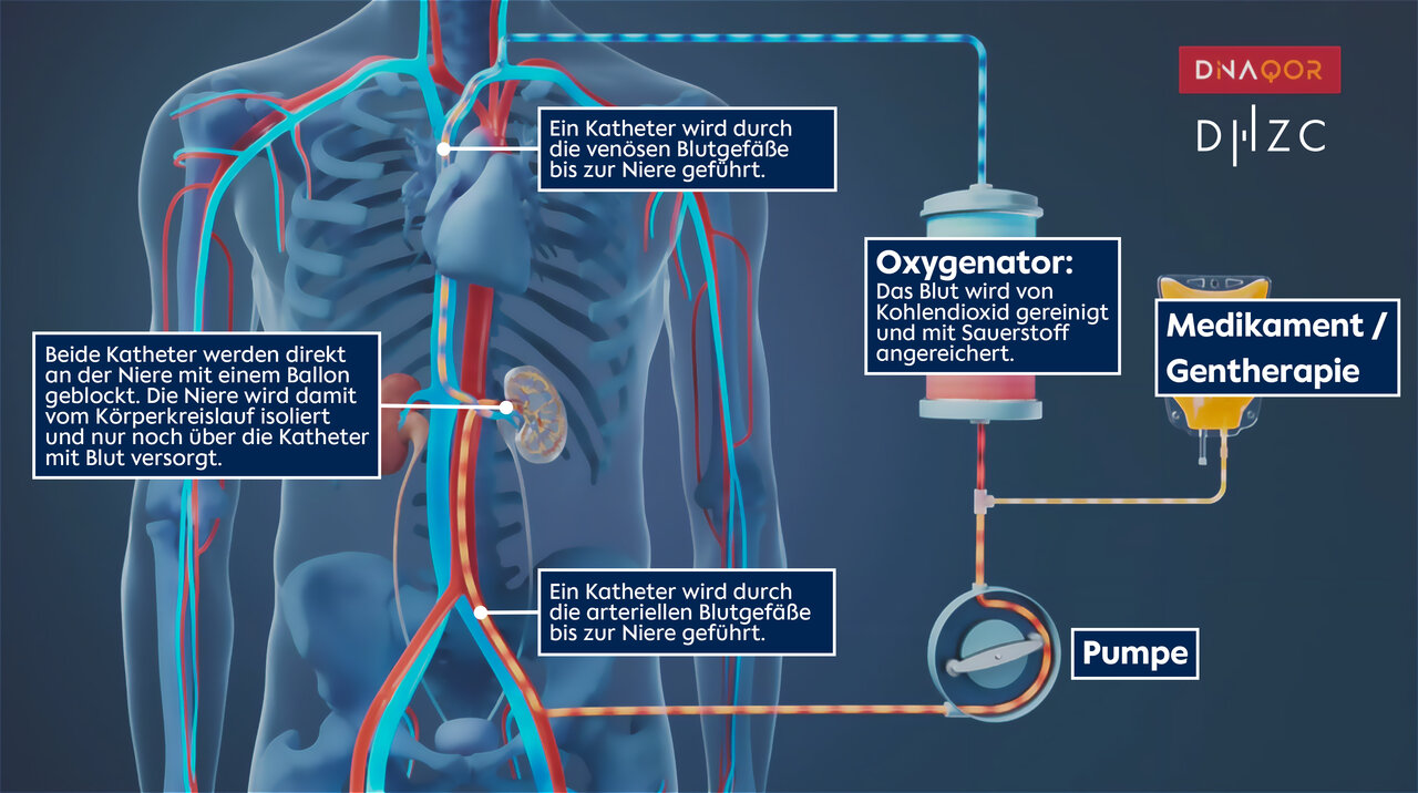 Eine schematische Darstellung des menschlichen Körpers mit Fokus auf die Nieren. Zwei Katheter sind dargestellt, die Blut zur Niere leiten. Ein Oxygenator reinigt das Blut von Kohlendioxid und reichert es mit Sauerstoff an. Schriftzüge erklären die Funktionen der einzelnen Komponenten.
