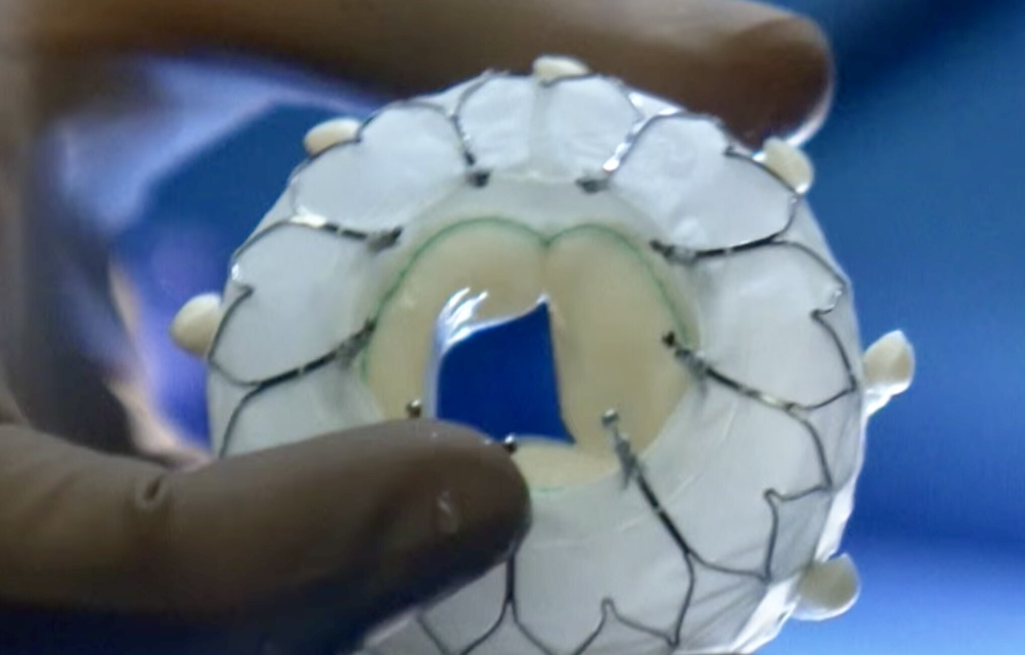 Eine Hand hält ein transparentes medizinisches Gerät in Form eines ringförmigen Objekts. Das Gerät hat eine zentrale Öffnung und ist mit feinen Drähten verziert. Der Hintergrund ist unscharf und blau.