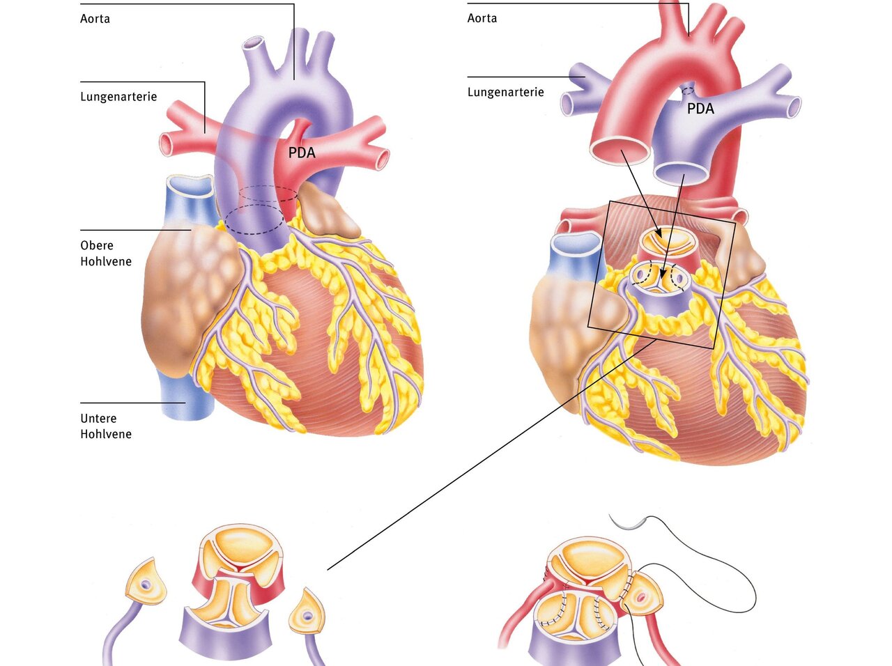 Die Abbildung zeigt das menschliche Herz mit beschrifteten Blutgefäßen, darunter Aorta, Lungenarterie und Hohlvenen. Ein vergrößertes Detailbild zeigt die Verbindung zwischen Lungenarterie und Aorta, bekannt als PDA (Ductus arteriosus), in zwei Ansichten.