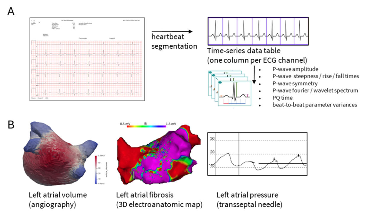 Maschinelles Lernen u.a. zur Vorhersage von Parametern der atrialen Kardiomyopathie bei Herzinsuffizienz