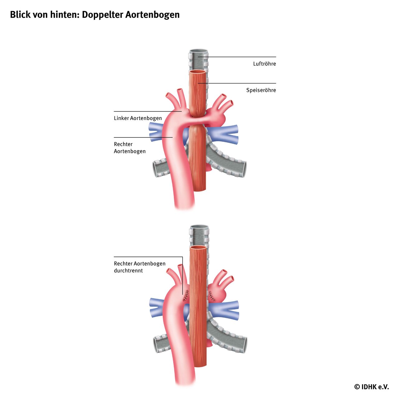 Diese Illustration zeigt einen doppelt angelegten Aortenbogen aus einer Rückansicht. Oben sind der linke und rechte Aortenbogen sowie die Luft- und Speiseröhre abgebildet. Unten wird der rechte Aortenbogen dargestellt, der durchtrennt ist. Die wichtigsten Strukturen sind beschriftet.