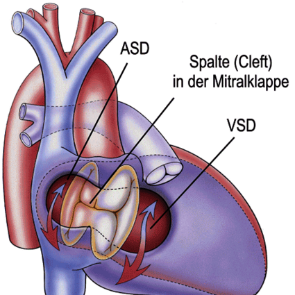 Atrioventrikulärer Septumdefekt (AVSD)