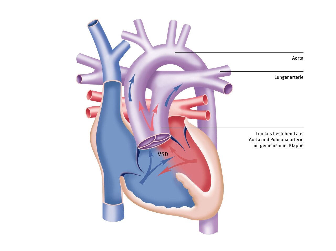 Illustration eines Herzens mit hervorgehobenen Blutgefäßen. Beschriftungen zeigen die Aorta, die Lungenarterie und den Ventrikelseptumdefekt (VSD). Pfeile verdeutlichen den Blutfluss zwischen den Kammern und großen Gefäßen. Ein Diagramm zur Illustration der Herzstruktur und -funktion.