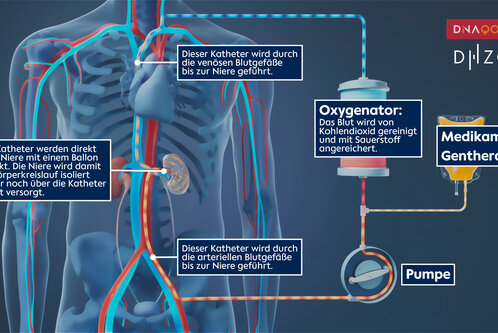 Eine schematische Darstellung des menschlichen Körpers mit Fokus auf die Nieren und zwei Kathetern. Ein Katheter führt Blut zu den Nieren, während der andere es abführt. Ein Oxygenator reinigt das Blut und reichert es mit Sauerstoff an. Eine Pumpe sorgt für den Blutfluss.