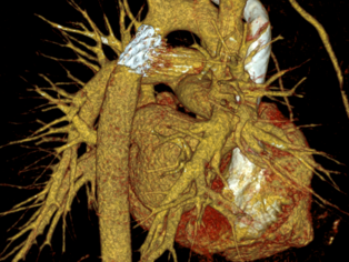 Bildbeschreibung: Eine detaillierte 3D-Darstellung des Herzens mit den umgebenden Blutgefäßen. Die anatomischen Strukturen sind prominent hervorgehoben, um die komplexe Form und Anordnung der Herz- und Gefäßsysteme zu verdeutlichen.