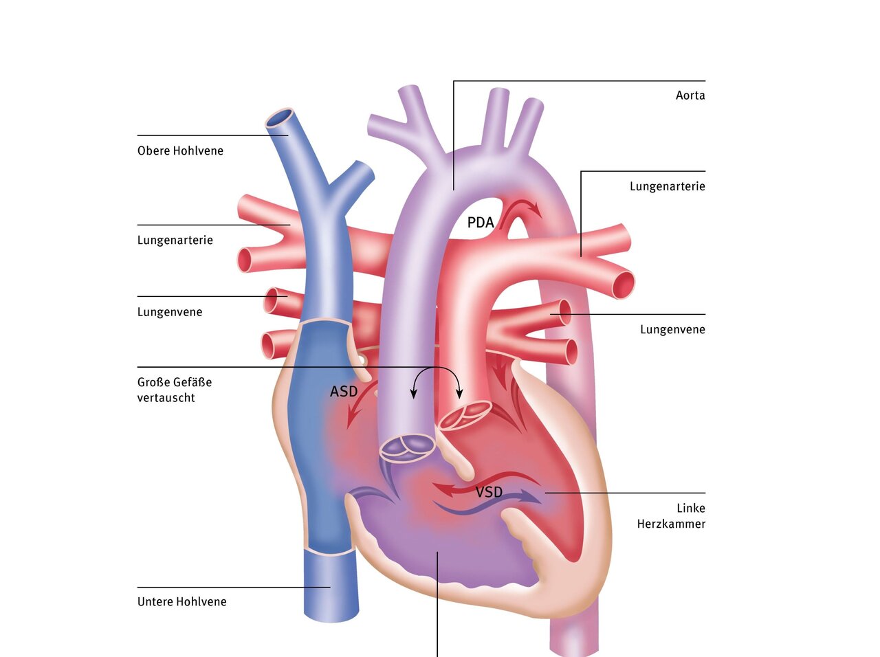 Illustration des menschlichen Herzens mit beschrifteten großen Gefäßen wie Aorta, Lungenarterie und Lungenvene. Es zeigt auch Herzfehler wie ASD (atrialer Septumdefekt) und VSD (ventrikulärer Septumdefekt). Die Struktur verdeutlicht die Blutflussrichtung im Herzen.