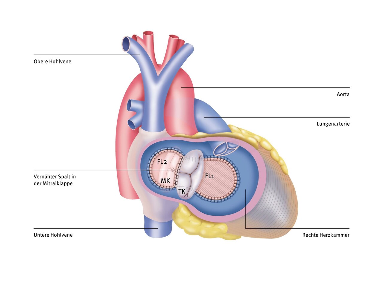 Illustration eines menschlichen Herzens mit beschrifteten Teilen, darunter die obere Hohlvene, untere Hohlvene, Aorta und Lungenarterie. Der Schnitt zeigt die rechte Herzkammer und die Mitralklappe mit einem verängten Spalt.