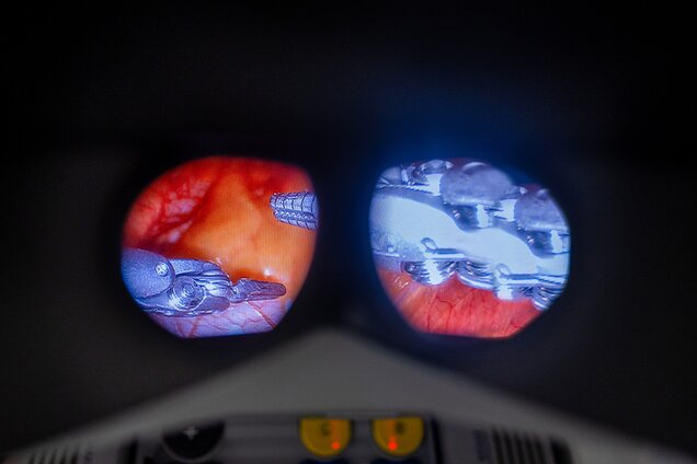 Die Abbildung zeigt einen Blick durch eine Operationslupe, die eine chirurgische Szene zeigt. Auf der linken Seite sind chirurgische Instrumente zu sehen, während die rechte Seite ein inneres Organ zeigt. Der Hintergrund ist dunkel und fokussiert auf den Operationsbereich.