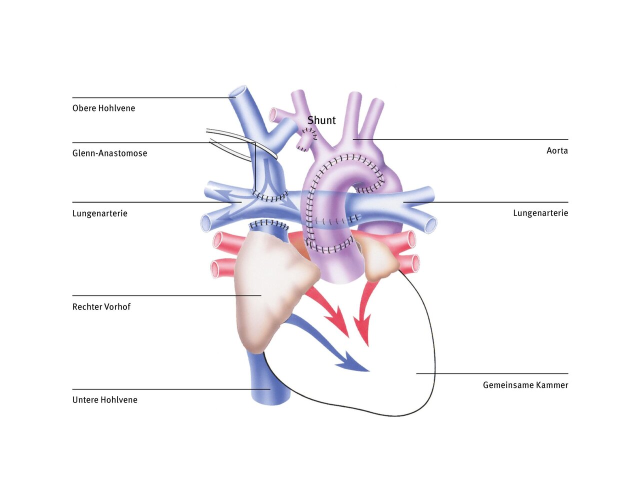 Das Bild zeigt eine schematische Darstellung des menschlichen Herzens mit wichtigen anatomischen Strukturen. Namentlich sind die Obere Hohlvene, Glenn-Anastomose, Lungenschlagader, rechter Vorhof, untere Hohlvene, Aorta und die gemeinsame Kammer gekennzeichnet.