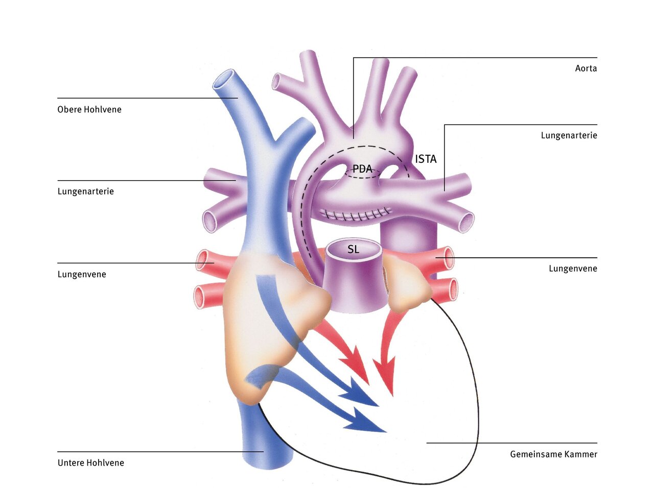 Diagramm des menschlichen Herzens mit beschrifteten Hauptgefäßen wie Aorta, Lungenarterie, Lungenvene und Hohlvenen. Es zeigt den Blutfluss durch die Herzstrukturen, einschließlich der gemeinsamen Kammer und speziellen Bezeichnungen wie PDA und SL. Die Darstellung dient zur Veranschaulichung der Herzanatomie.