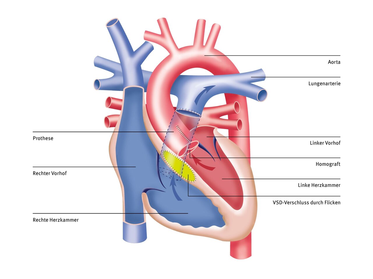 Diagramm eines Herzens mit beschrifteten Komponenten, einschließlich Aorta, Lungenarterie, Vorhöfen und Kammern. Es zeigt auch eine Prothese und einen homographischen Einsatz für einen VSD-Verschluss. Das Bild dient der Veranschaulichung der Herzstruktur nach einer Operation.