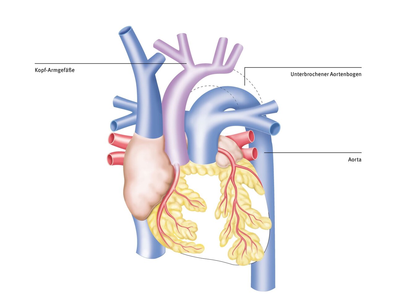 Illustration des menschlichen Herzkreislaufsystems, das wichtige Blutgefäße zeigt. Zentrale Blutgefäße sind bezeichnet: Aorta, Kopf-Armgefäße und der unterbrochene Aortenbogen. Die Darstellung umfasst auch den Herzbereich und die Lungenschlagadern.