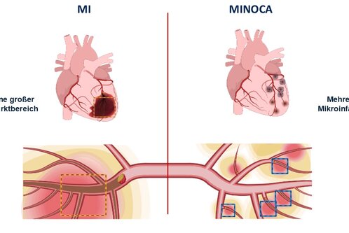Das Bild zeigt zwei Herzen, die verschiedene Arten von Herzinfarkten darstellen. Links ist ein Herz mit einem großen Infarktbereich (MI) abgebildet, rechts ein Herz mit mehreren Mikroinfarkten (MINOCA). Unterhalb sind schematische Darstellungen der Blutgefäße, die die Unterschiede verdeutlichen.