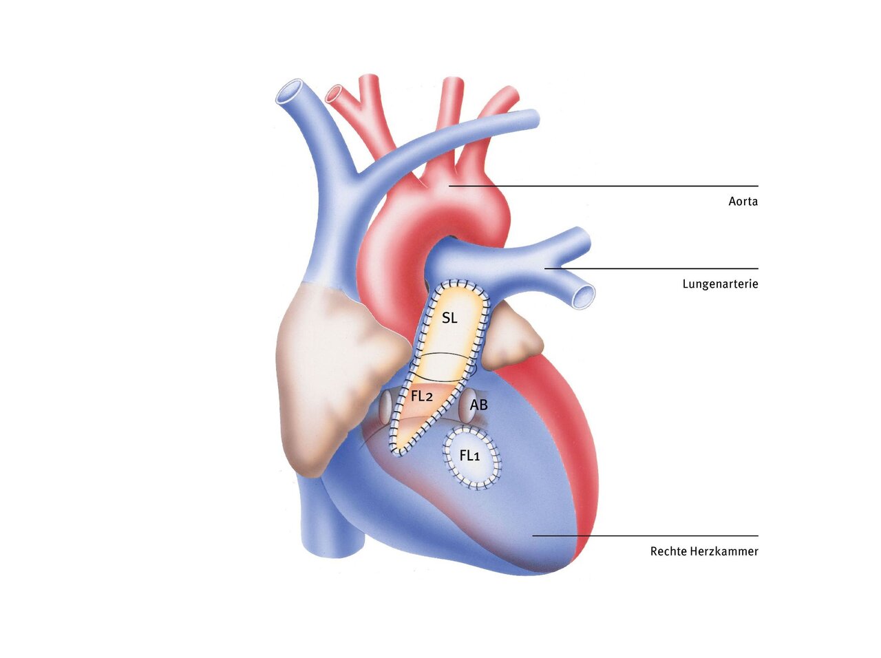 Illustration eines menschlichen Herzens mit beschrifteten Blutgefäßen. Zu sehen sind die Aorta, die Lungenarterie, die rechte Herzkammer sowie verschiedene Bereiche innerhalb des Herzens, die entsprechend mit den Abkürzungen SL, FL1, FL2 und AB gekennzeichnet sind.