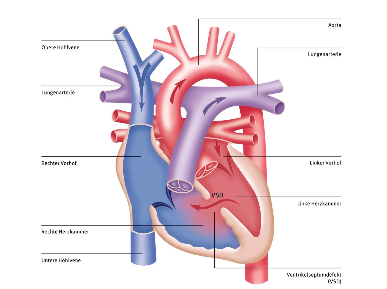 Das Bild zeigt eine schematische Darstellung des menschlichen Herzens mit beschrifteten Bereichen: rechter Vorhof, rechte Herzkammer, linker Vorhof, linke Herzkammer, Aorta, Lungenarterie sowie die Bezeichnung Ventriculoseptumdefekt (VSD). Die Hauptstrukturen sind in verschiedenen Farben hervorgehoben.