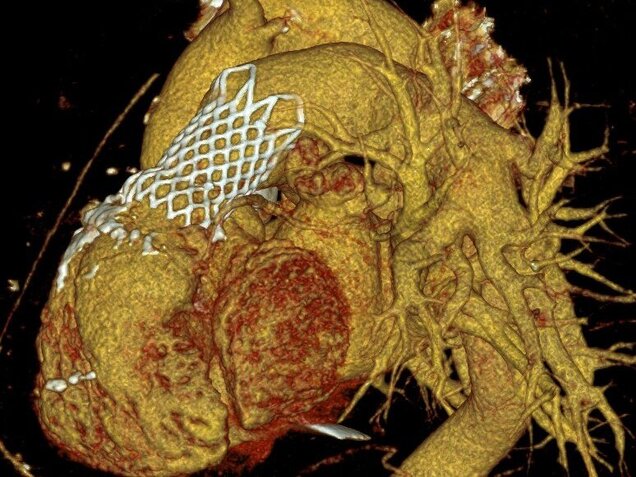 Das Bild zeigt eine 3D-Darstellung eines menschlichen Herzens, das in Gelb und Rot hervorgehoben ist. Bindegewebe oder eine Netzstruktur ist sichtbar. Um das Herz verlaufen Blutgefäße, was die anatomische Struktur des Herzens verdeutlicht.