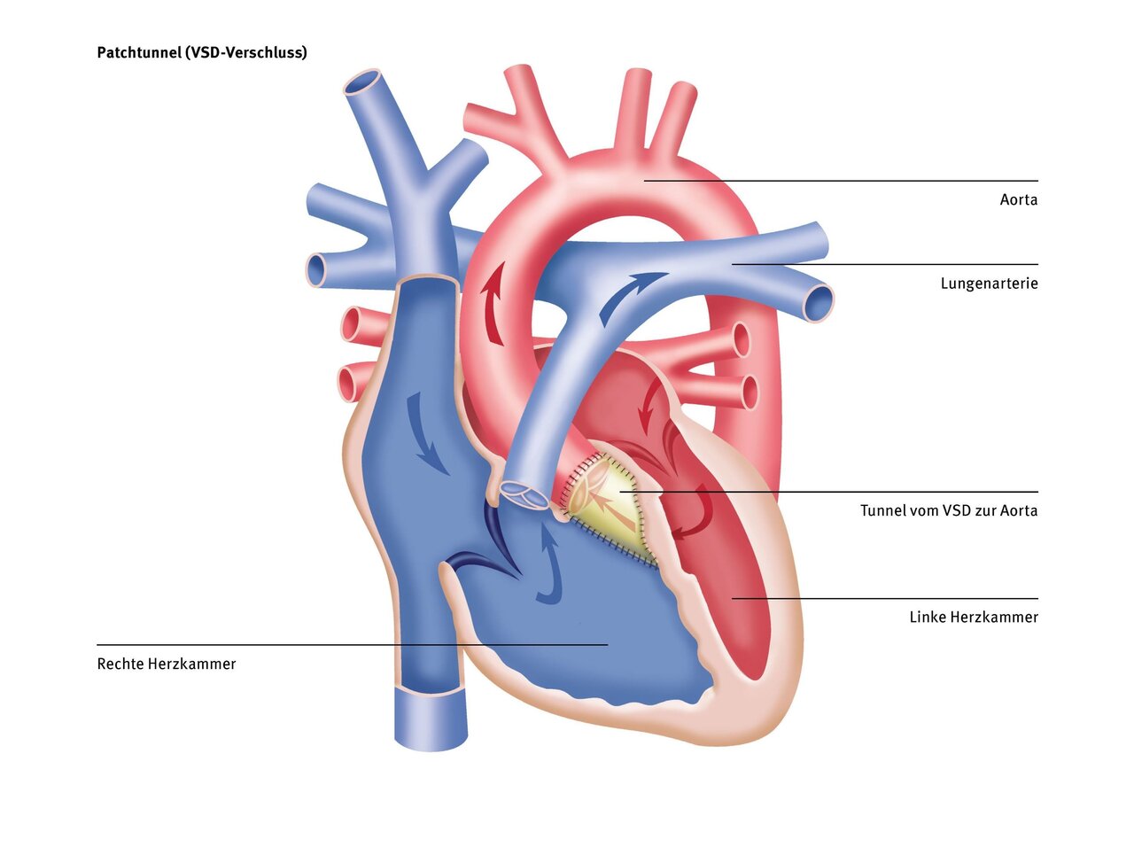 Diagramm des menschlichen Herzens mit dem Fokus auf den Patchkanal (VSD-Verschluss). Die Aorta, die Lungenarterie, der Tunnel vom VSD zur Aorta sowie die linke und rechte Herzkammer sind angezeigt, um die Herzstruktur und den Blutfluss darzustellen.