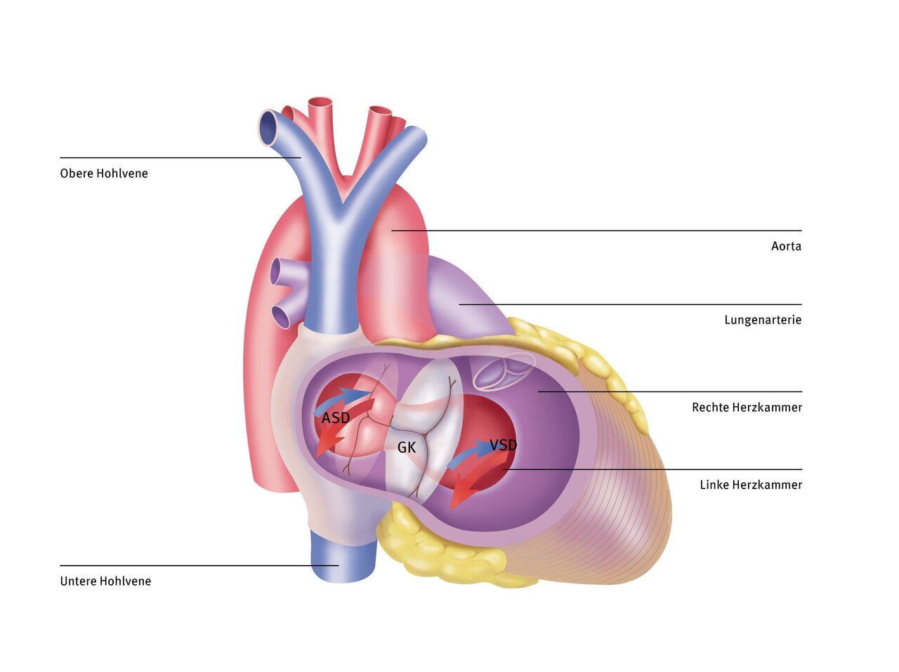Diagramm eines menschlichen Herzens mit Beschriftungen. Die Hauptstrukturen sind die Aorta, Lungenarterie, obere und untere Hohlvene sowie die rechte und linke Herzkammer. Es sind auch ASD (Atriumseptumdefekt) und VSD (Ventrikelseptumdefekt) eingezeichnet.