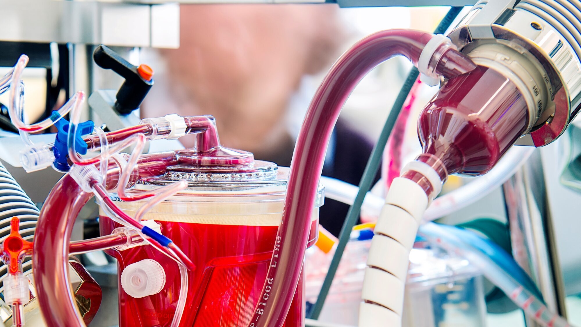 Das Bild zeigt ein medizinisches Gerät zur Blutbehandlung. Rote und transparente Schläuche sind miteinander verbunden, während eine durchsichtige Kammer das Blut enthält. Das Gerät ist Teil einer komplexen Technik, die wahrscheinlich für eine Herzoperation oder Bluttransfusion verwendet wird.
