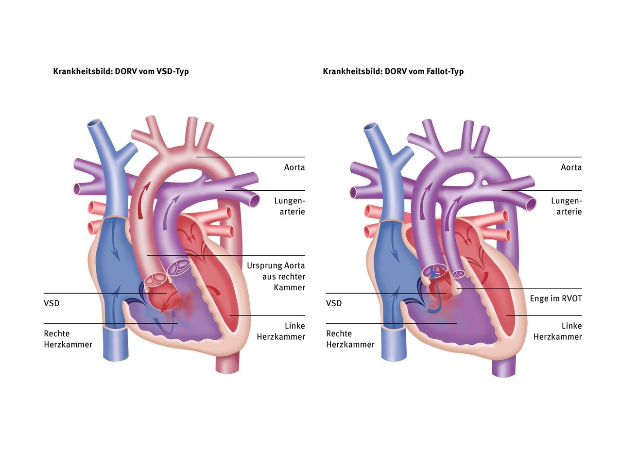 Zwei anatomische Darstellungen des Herzens, die die Erkrankungen DORV vom VSD-Typ und DORV vom Fallot-Typ zeigen. Beide Diagramme heben die Hauptstrukturen wie Aorta, Lungenarterie, und VSD hervor, sowie wichtige Unterschiede in der Herzstruktur und -funktion.