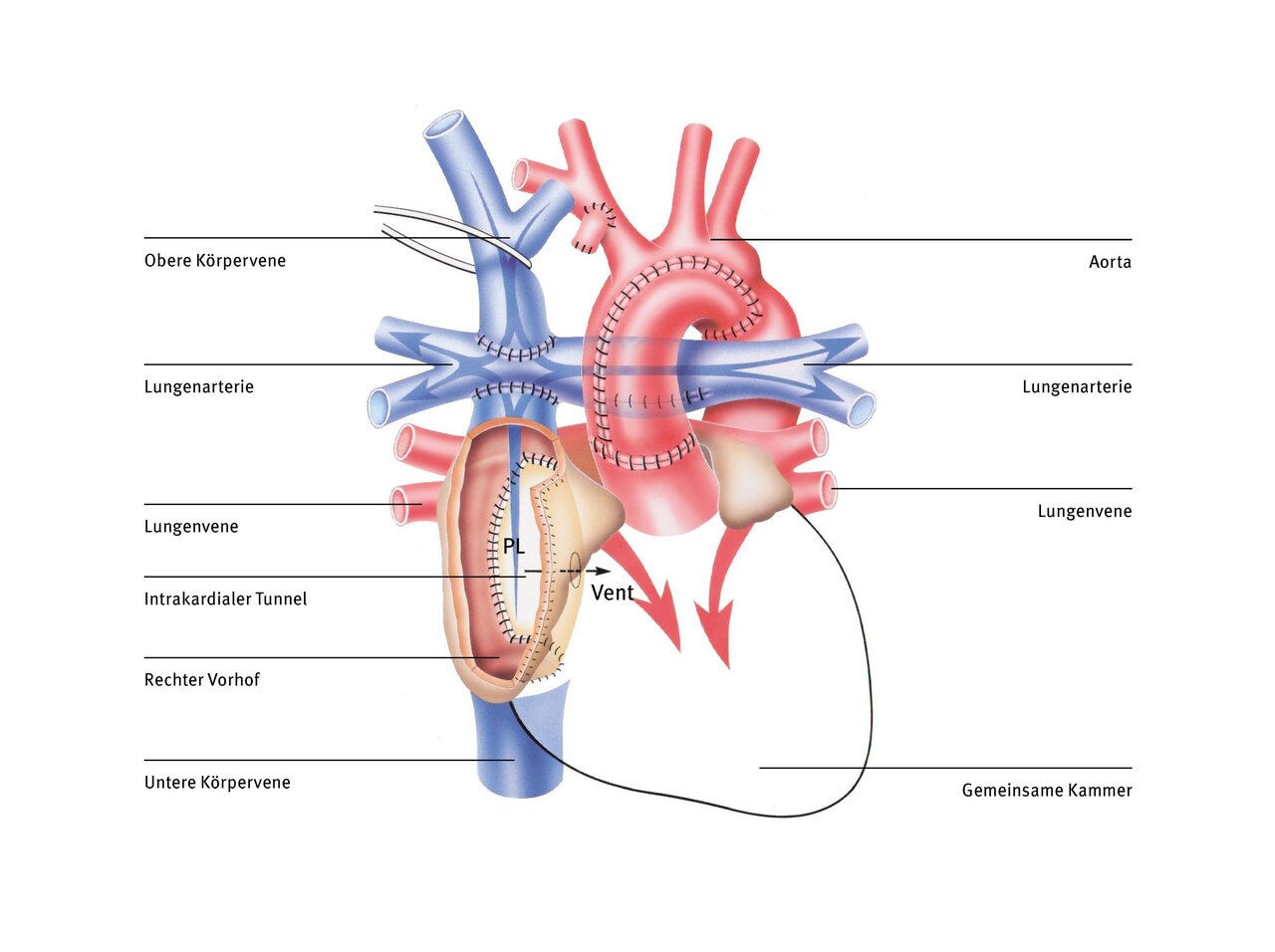 Diagramm des menschlichen Herzens mit Beschriftungen der Hauptblutgefäße, einschließlich der oberen und unteren Körpervenen, Lungenarterien, Lungenvenen und der Aorta. Es zeigt auch den intrakardialen Tunnel, den rechten Vorhof sowie die gemeinsame Kammer.