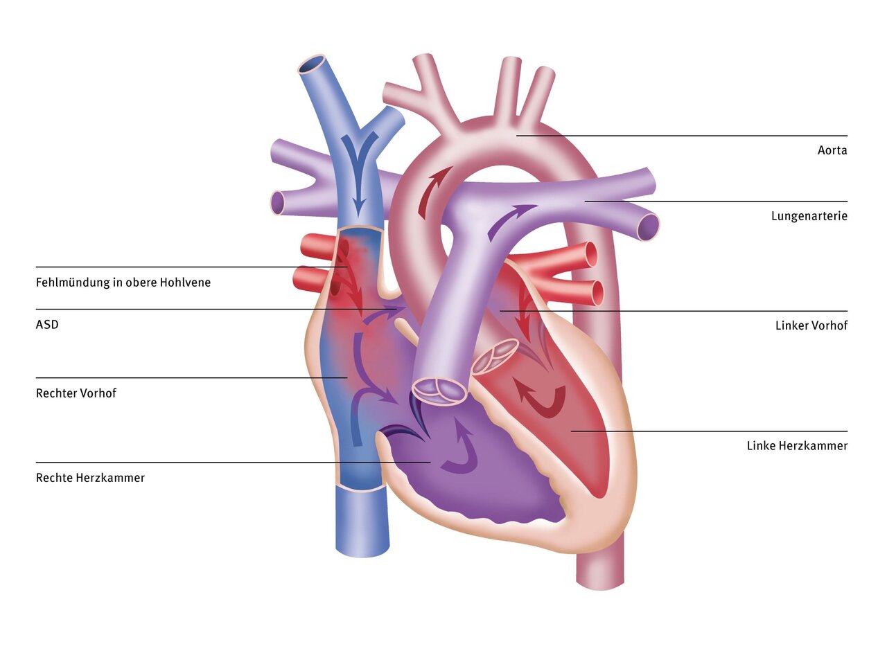 Illustration eines menschlichen Herzens mit Beschriftungen der verschiedenen Bereiche: Aorta, Lungenschlagader, linker und rechter Vorhof sowie linke und rechte Herzkammer. Einige medizinische Zustände wie ASD und eine Fehlmündung in die obere Hohlvene sind ebenfalls markiert.