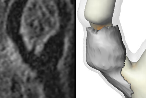 Neben einem dunklen, verschwommenen Bild ist ein detailliertes 3D-Modell eines Knies zu sehen, das einen Riss im Gelenk zeigt. Das Modell hebt die Verletzung hervor und verdeutlicht die Anatomie des Knies.