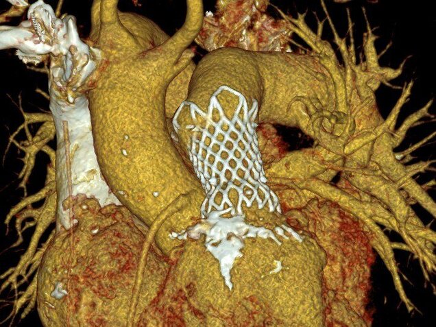 Eine medizinische Bildgebung zeigt das Herz, umgeben von anatomischen Gefäßen. Ein Netzimplantat ist sichtbar, das zur Unterstützung der Gefäßstruktur eingesetzt wurde. Die Oberfläche ist unregelmäßig und weist verschiedene Farben auf, die die Textur und die Veränderungen im Gewebe darstellen.