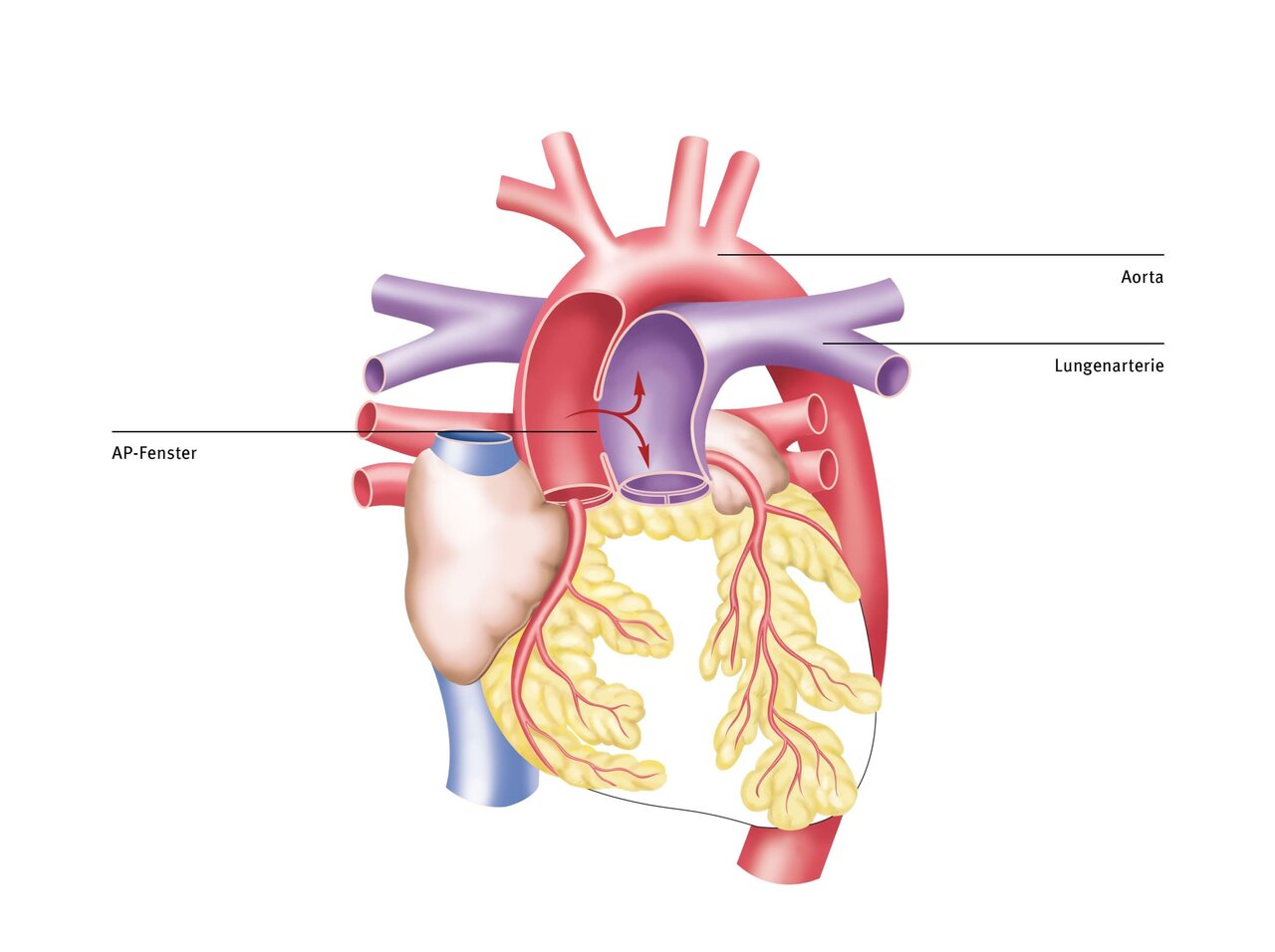 Dieses Diagramm zeigt das menschliche Herz mit wichtigen Strukturen, einschließlich der Aorta, der Lungenarterie und dem AP-Fenster. Die Darstellung hebt die Blutgefäße hervor, die das Herz mit den Lungen und dem restlichen Körper verbinden.