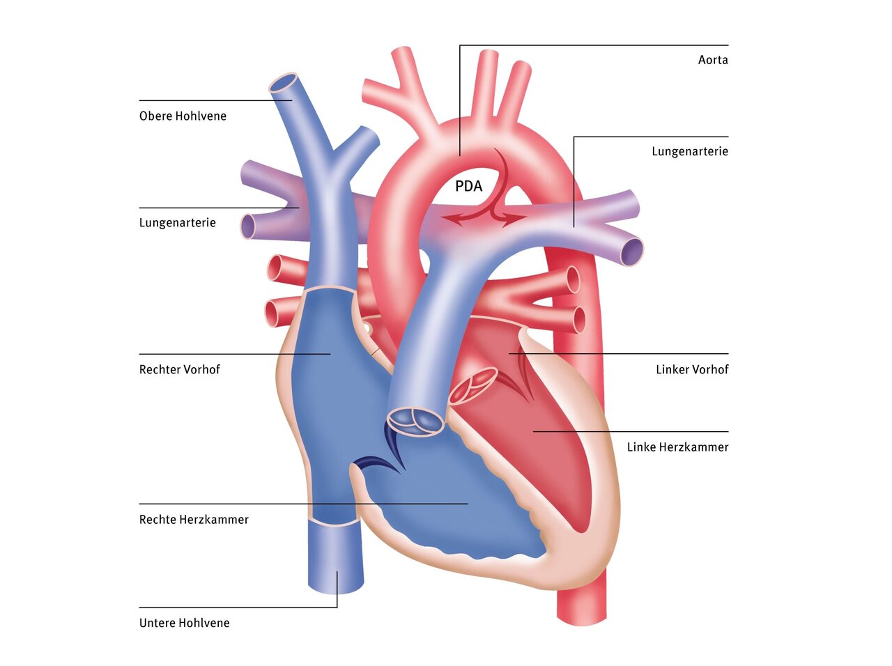 Das Bild zeigt eine schematische Darstellung des menschlichen Herzens mit seinen Hauptbestandteilen. Wichtige Teile sind die Aorta, die oberen und unteren Hohlvenen, die Vorhöfe (rechter und linker) sowie die Herzkammern (rechte und linke). Zusätzlich wird die Lungenschlagader und der PDA (Ductus arteriosus) angezeigt.