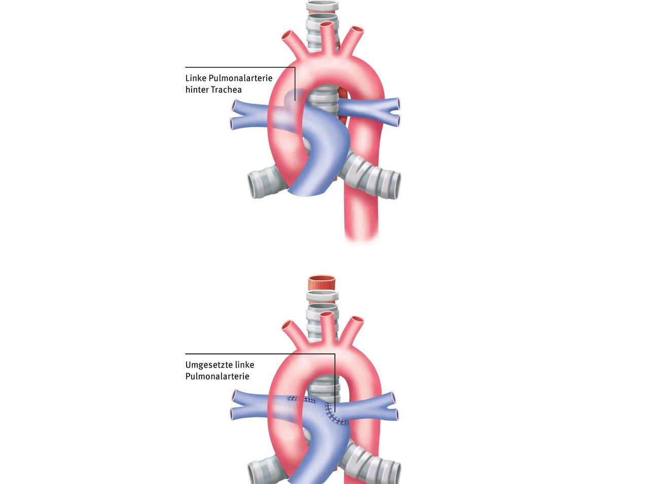 Das Bild zeigt zwei schematische Darstellungen des menschlichen Herzens. Oben ist die linke Pulmonalarterie hinter der Trachea zu sehen. Unten ist die umgesetzte linke Pulmonalarterie abgebildet, die eine andere Position zeigt. Beide Illustrationen verdeutlichen die Anordnung der Arterien.