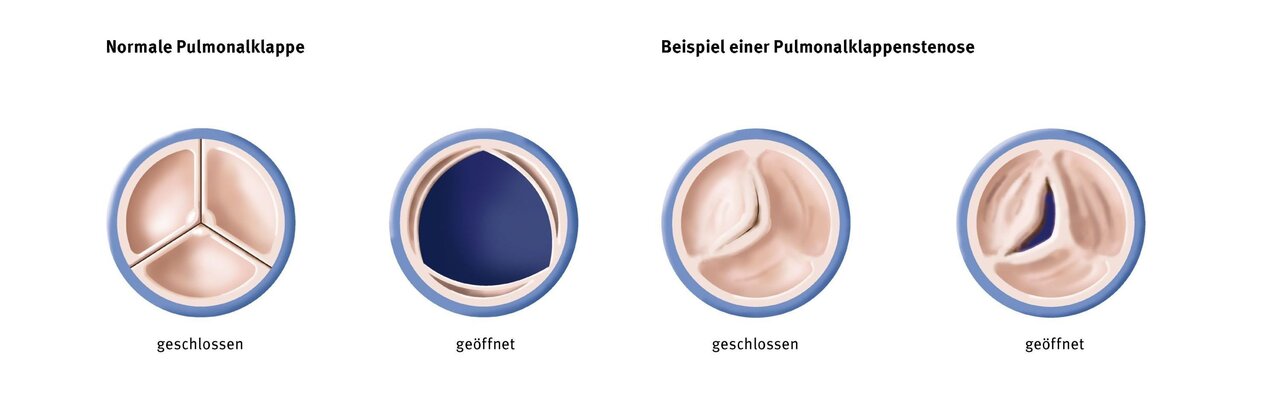 Illustration von Pulmonalklappen: links eine normale Klappe in offenen und geschlossenen Positionen, rechts eine Klappe mit Pulmonalkappenstenose, ebenfalls in offenen und geschlossenen Zuständen. Beschriftungen zeigen die jeweiligen Zustände.
