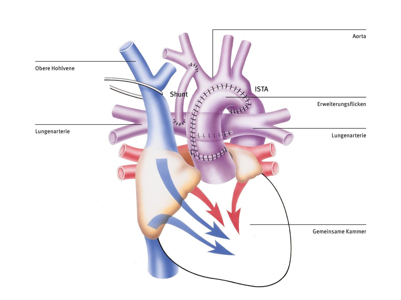 Diagramm des menschlichen Herzens mit beschrifteten Blutgefäßen. Zu sehen sind die obere Hohlvene, Aorta, Lungenschlagader, gemeinsame Kammer und Erweitungsflicken. Pfeile zeigen die Richtung des Blutflusses an. Illustratives Bild zur Erklärung der Herzstruktur und -funktion.