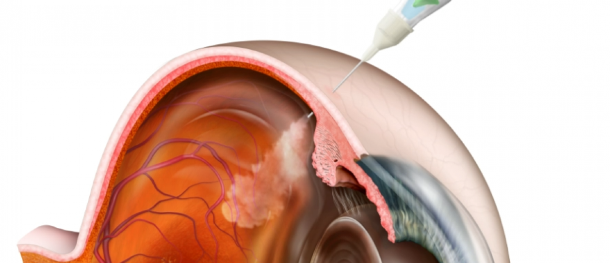 Eine schematische Darstellung eines menschlichen Auges, das eine Spritze zeigt, die in die Augenhöhle injiziert wird. Die Struktur des Auges, einschließlich Netzhaut und Blutgefäße, ist deutlich erkennbar. Die Injektion kann einem medizinischen Verfahren zur Behandlung von Augenerkrankungen zugeordnet werden.